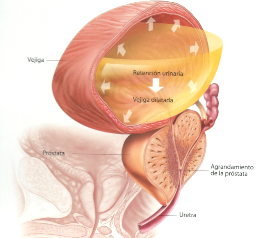 hiperplasia benigna prostata cie 10